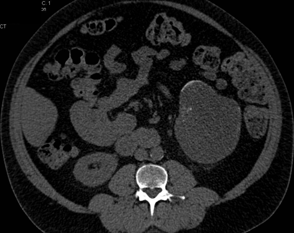 Bosniak 2F Cyst Needs Careful Follow-Up - CTisus CT Scan