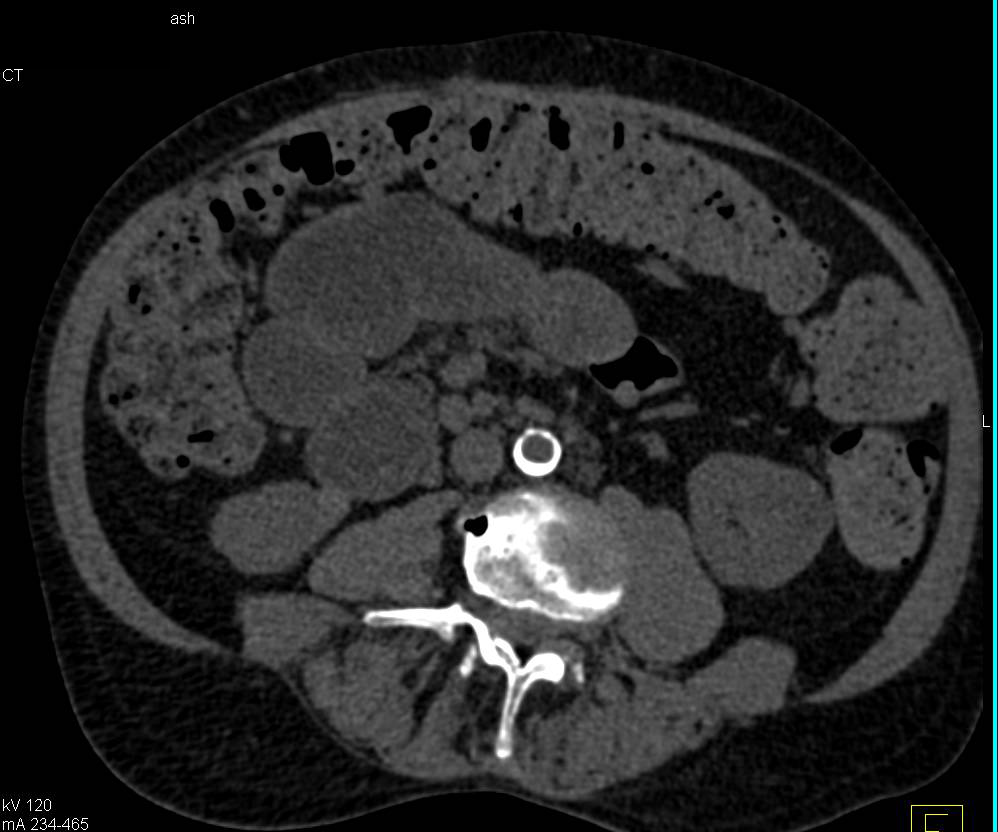 Papillary Renal Cell Carcinoma Left Kidney - CTisus CT Scan
