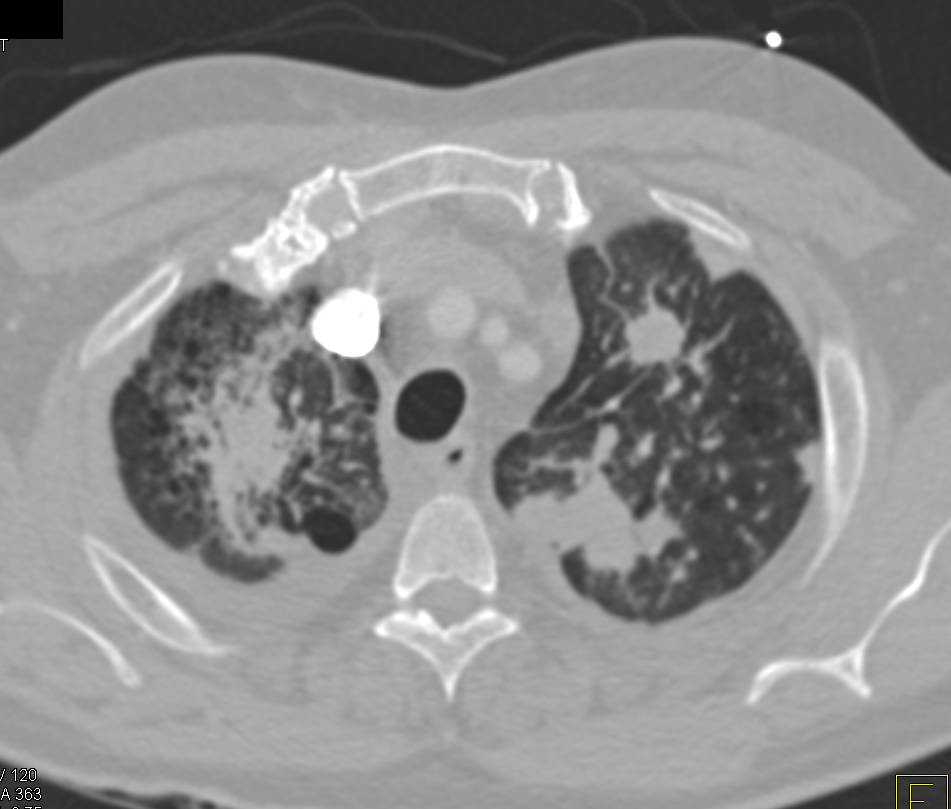 Metastatic Renal Cell Carcinoma to the Lungs - CTisus CT Scan
