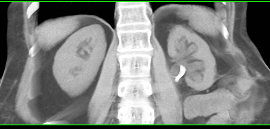 Thinning of the Cortex of the Left Kidney - CTisus CT Scan