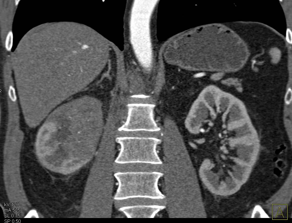 Transitional Cell Carcinoma Right Kidney with Adenopathy - CTisus CT Scan