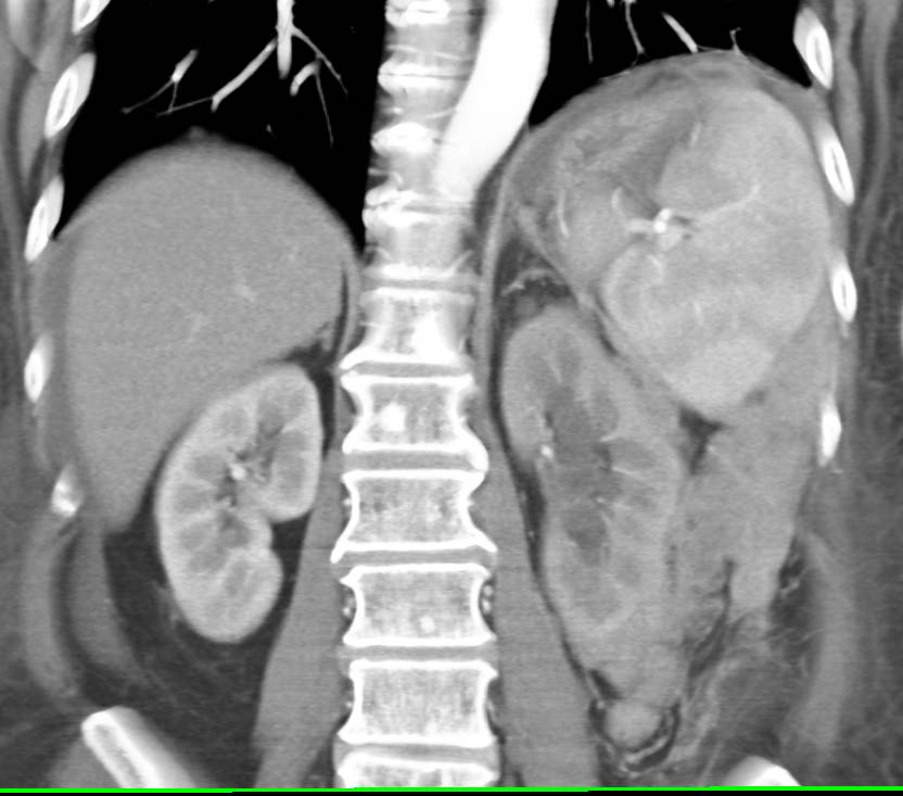 Obstructed Left Kidney with Adenopathy due to Lymphoma - CTisus CT Scan