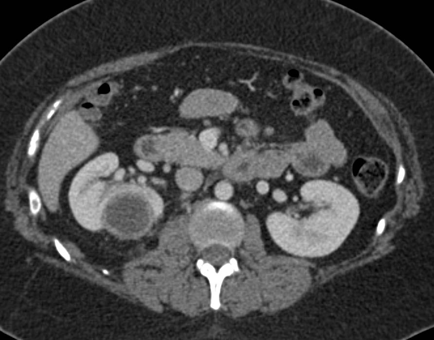 Renal Abscess - CTisus CT Scan