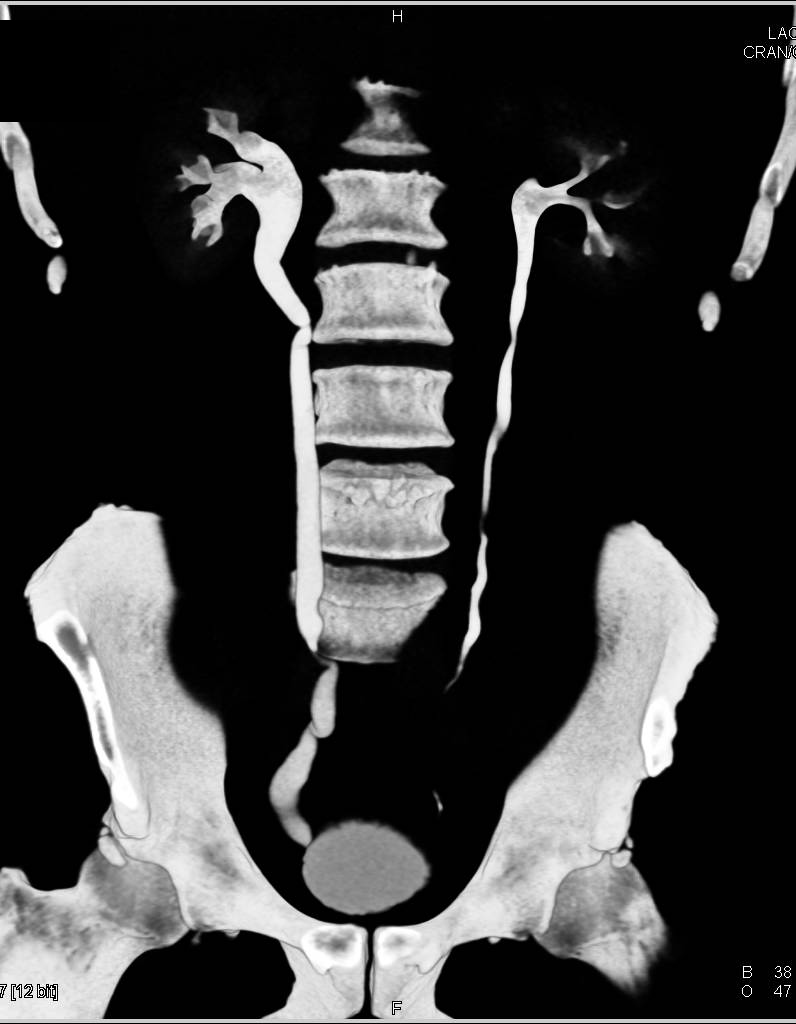 Dilated Right Ureter due to Stricture - CTisus CT Scan