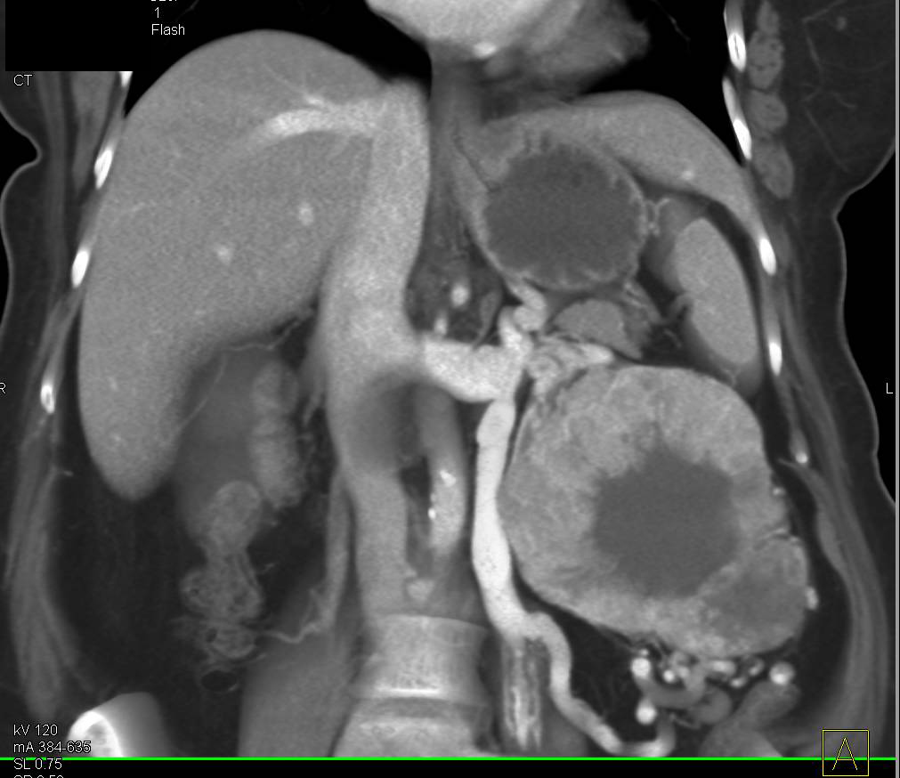Clear Cell Renal Cell Carcinoma with Neovascularity and Central Scar - CTisus CT Scan