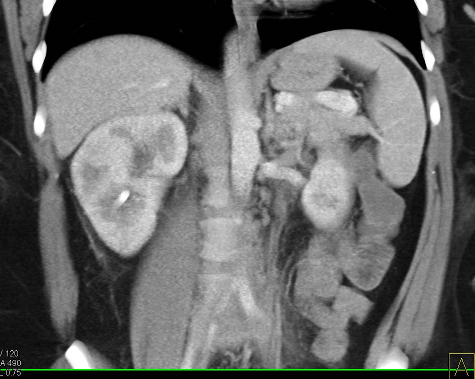 Retroperitoneal Fibrosis - CTisus CT Scan