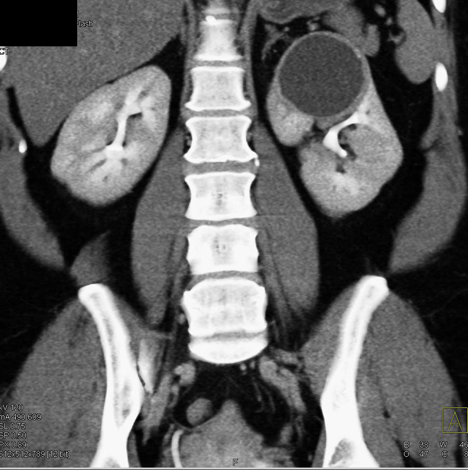 Bosniak 2F Renal Cyst - CTisus CT Scan