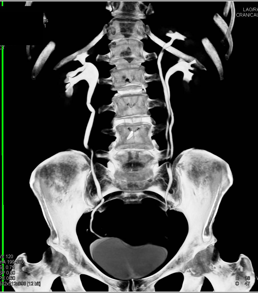 CT Urogram with Duplicated Collecting System on the Left - CTisus CT Scan