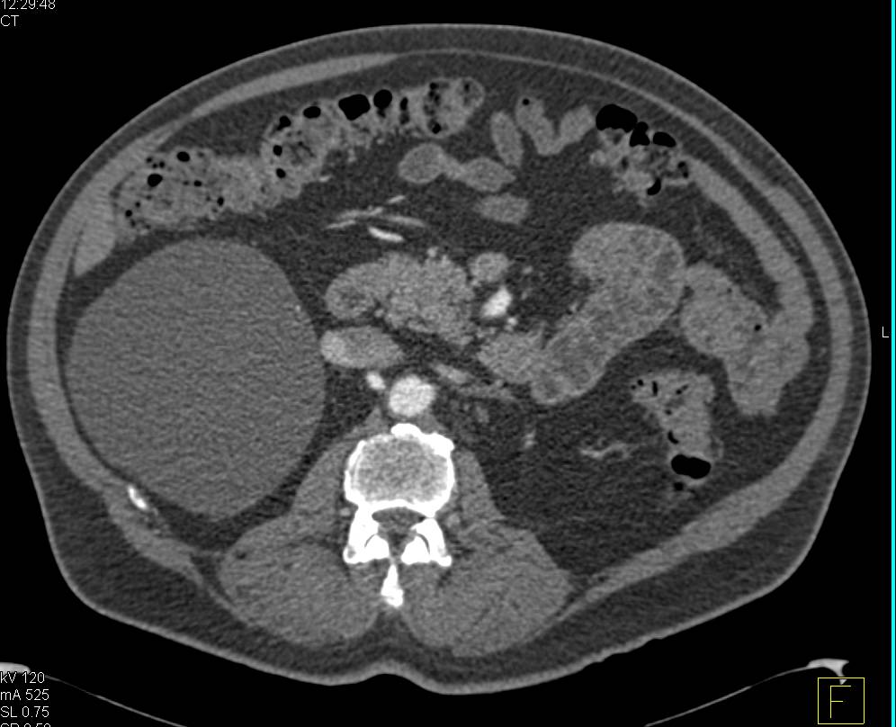Renal Cyst - CTisus CT Scan