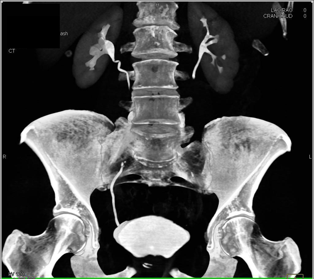 Normal CT Urogram - CTisus CT Scan