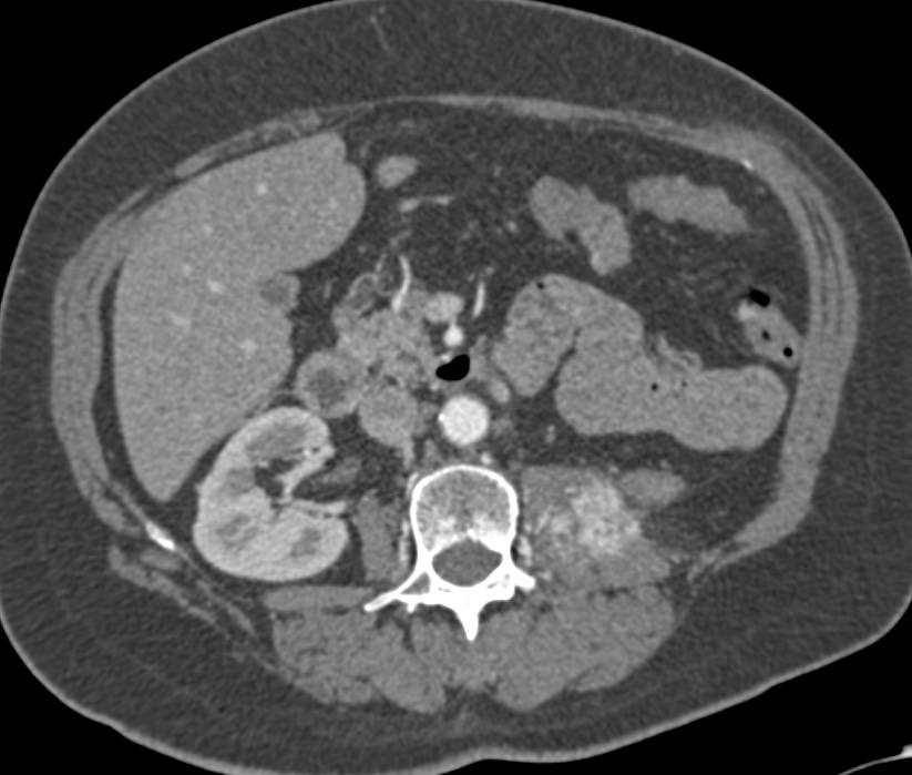 Recurrent Renal Cell Carcinoma with Metastases to Left Psoas Muscle and Bone - CTisus CT Scan