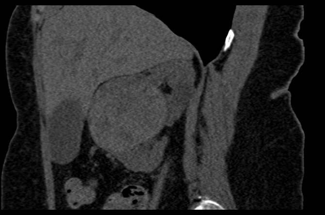 Papillary Renal Cell Carcinoma Right Kidney - CTisus CT Scan