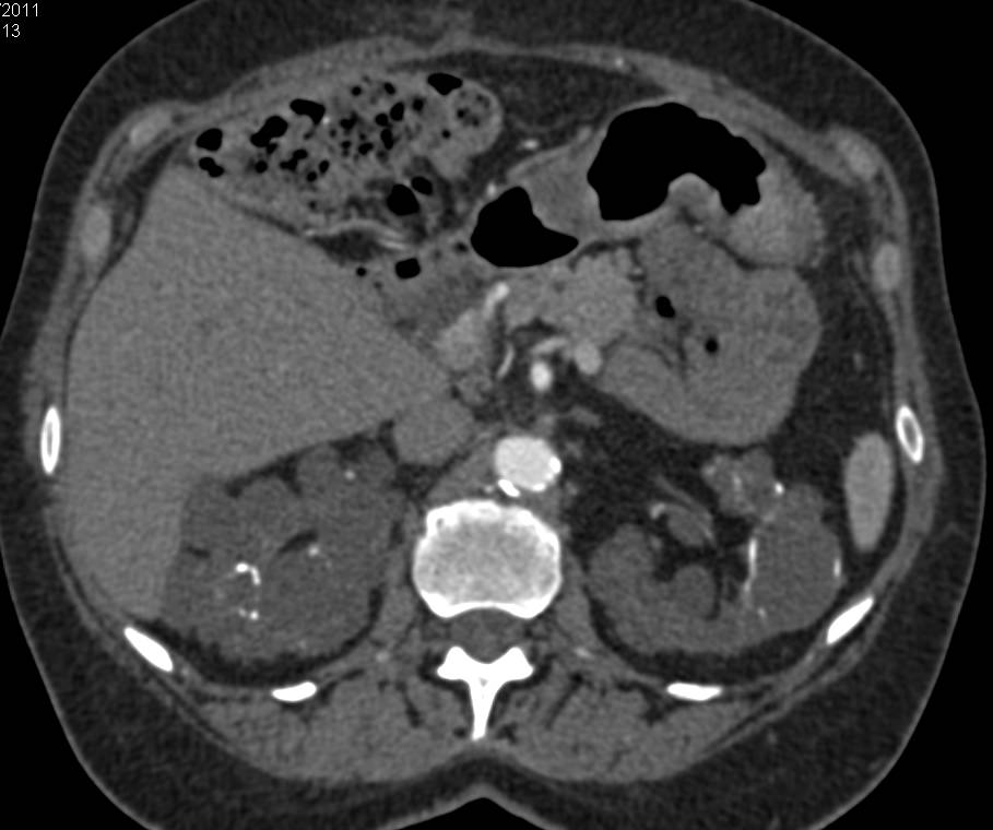 Polycystic Kidney Disease with Successful Left Renal Transplant - CTisus CT Scan
