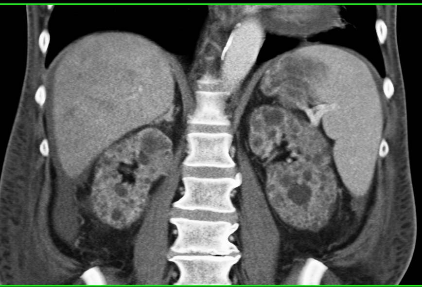 End Stage Renal Disease with Multiple Renal Cysts - CTisus CT Scan