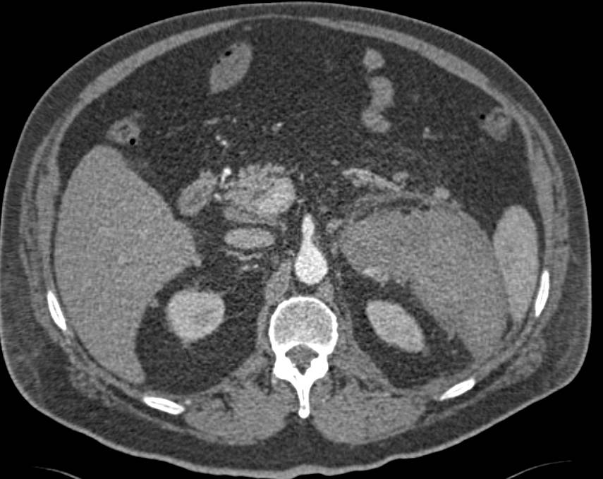 Right Renal Cell Carcinoma and Left Perirenal Bleed - CTisus CT Scan
