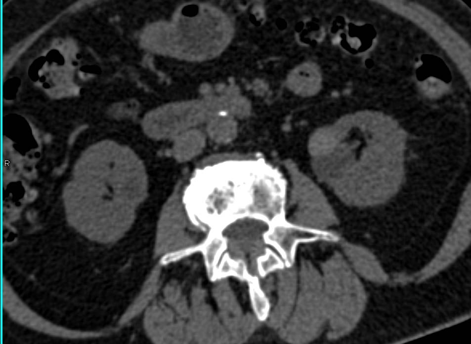 High Density Renal Cyst Left Kidney - CTisus CT Scan