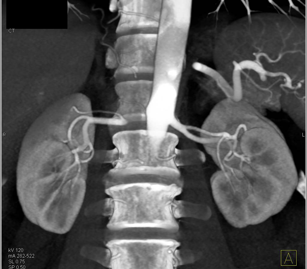 CTA Kidneys for Renal Donor wit Prehilar Branching of Right Renal Artery - CTisus CT Scan