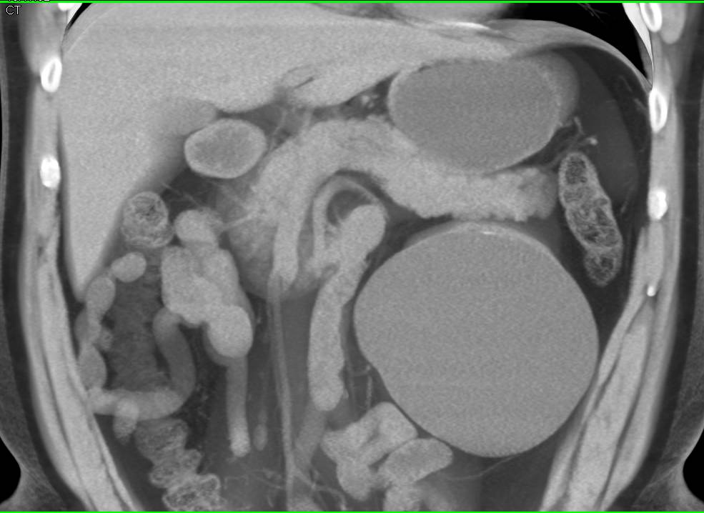 Bosniak 2 Cyst - CTisus CT Scan