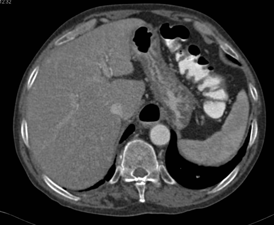 Renal Lymphoma Involves Both Kidneys - CTisus CT Scan