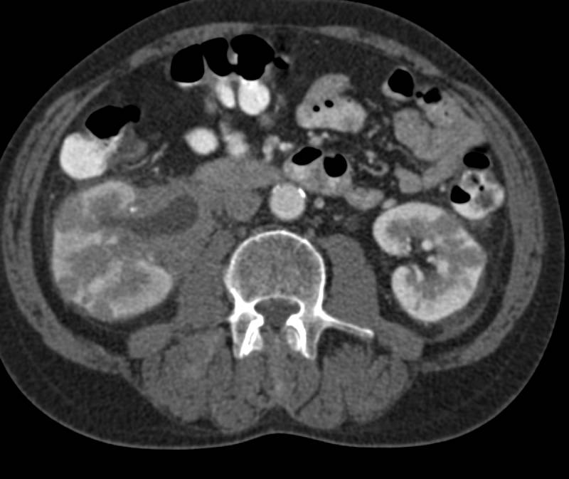 Lymphoma Involves the Kidneys and the Right Ureter - CTisus CT Scan