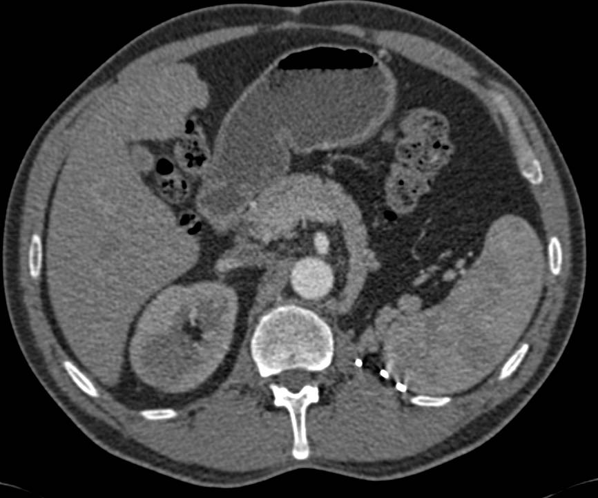 Classic Left Nephrectomy Bed Following Treatment - CTisus CT Scan