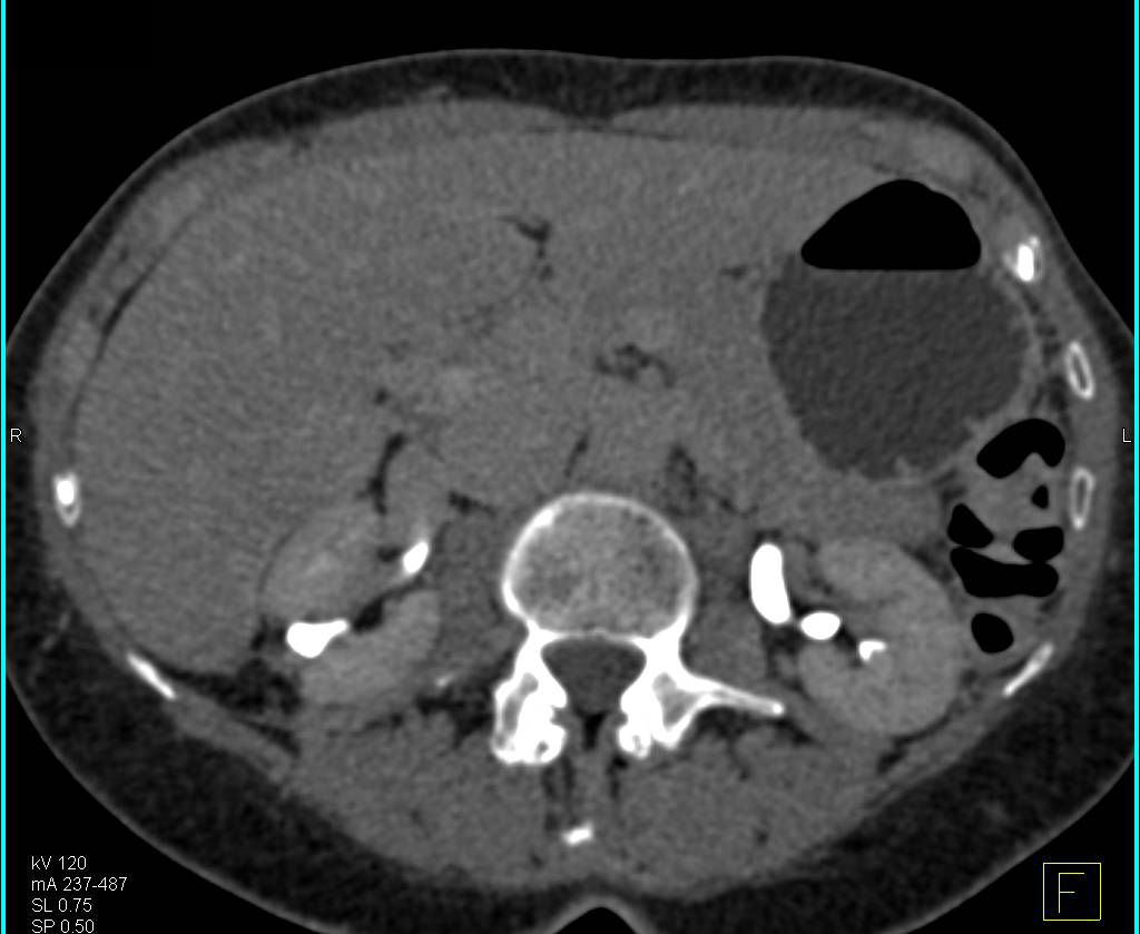 Scarring Upper Pole Right Kidney with Blunted Calyx - CTisus CT Scan