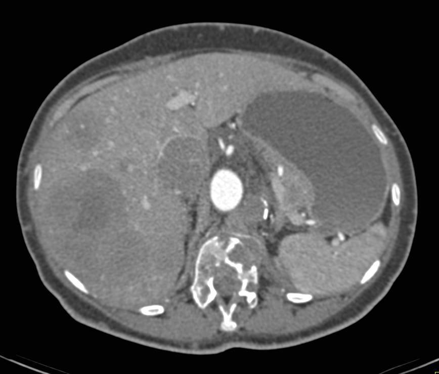 Recurrent Renal Cell Carcinoma with Liver, Bone and Local Recurrence - CTisus CT Scan
