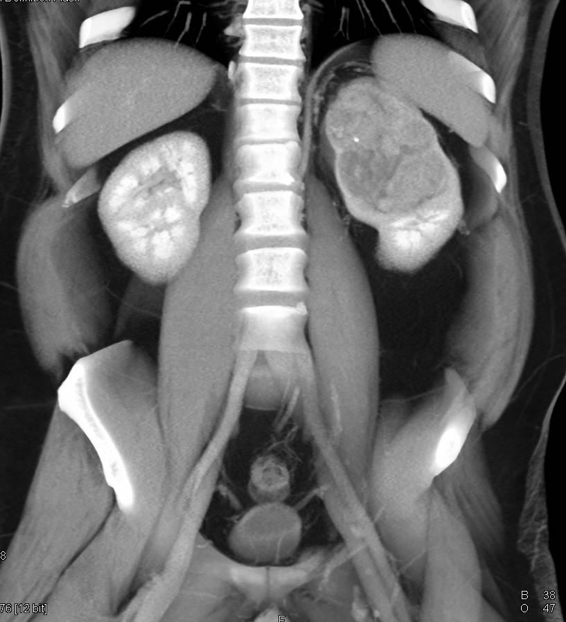 Clear Cell Renal Cell Carcinoma - CTisus CT Scan