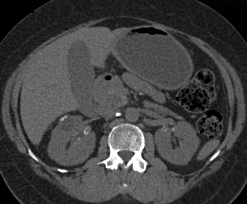 Diabetes with Extensive Vascular Calcifications in Renal Arteries - CTisus CT Scan