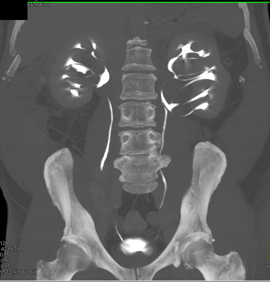Parapelvic Cysts Stretch the Calyces of Both Kidneys - CTisus CT Scan