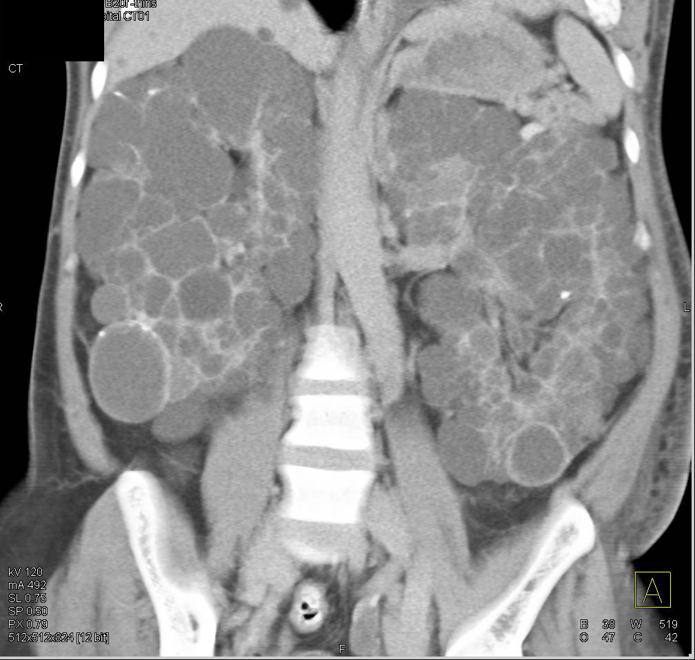 Polycystic Kidney Disease - CTisus CT Scan