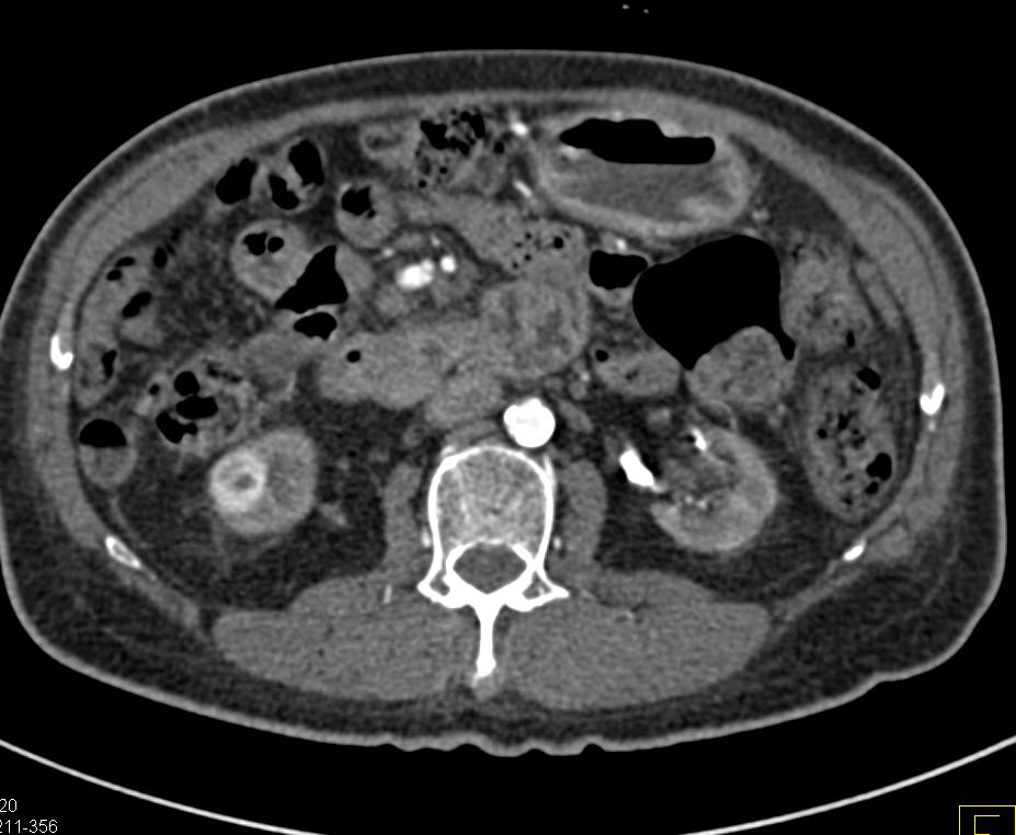 1cm Renal Cell Carcinoma in Patient with End Stage Renal Disease (ESRD) - CTisus CT Scan