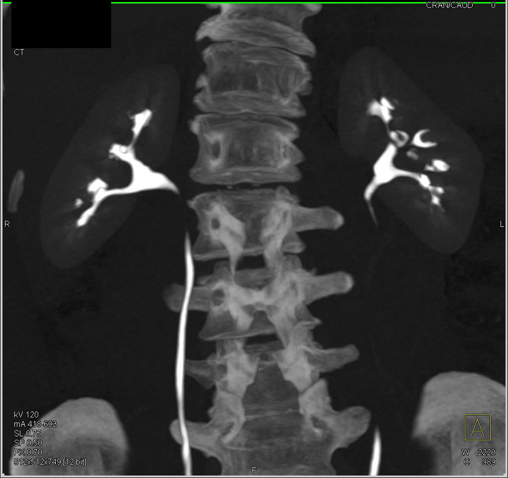 Normal CT Urogram - CTisus CT Scan