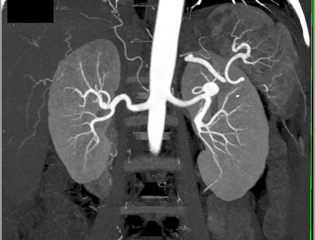 Left Renal Artery Aneurysm - CTisus CT Scan