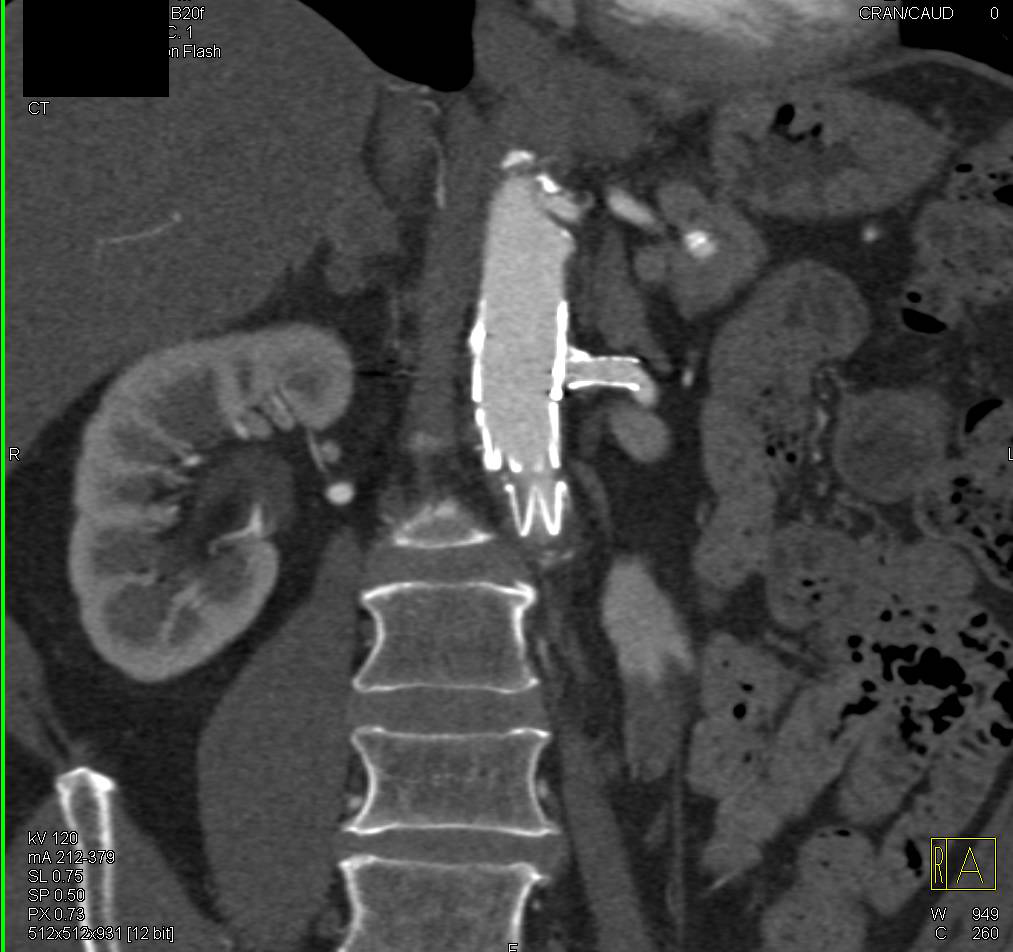2D and 3D of Endovascular Stents - CTisus CT Scan