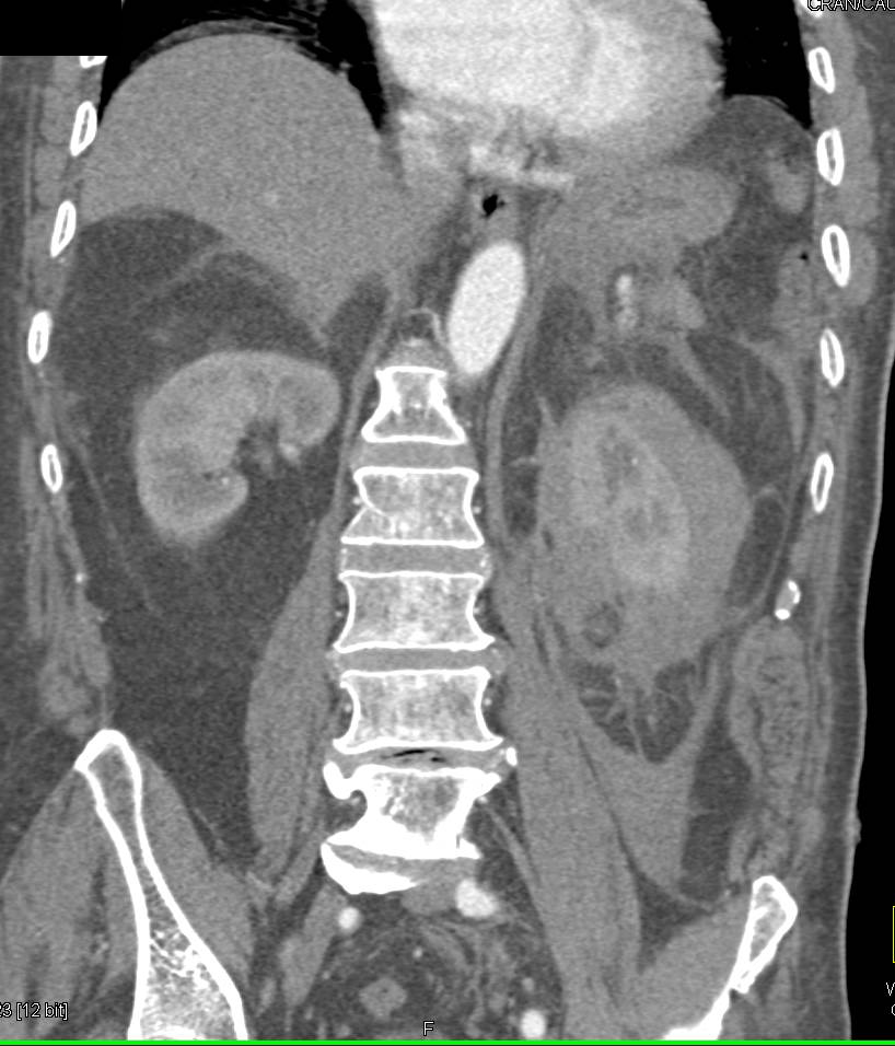 Perirenal Lymphoma left Kidney - CTisus CT Scan