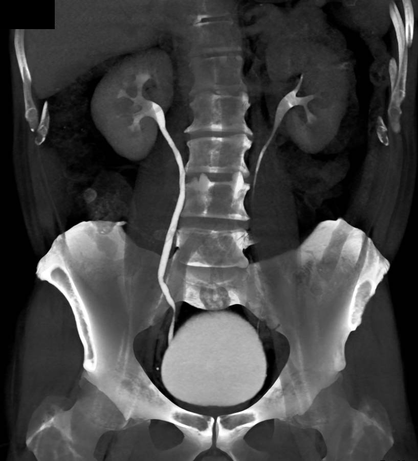 Normal CT Urogram - CTisus CT Scan