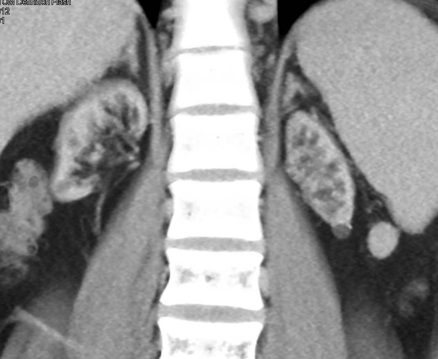 End Stage Renal Disease with Collaterals due to Superior Vena Cava (SVC) Occlusion - CTisus CT Scan