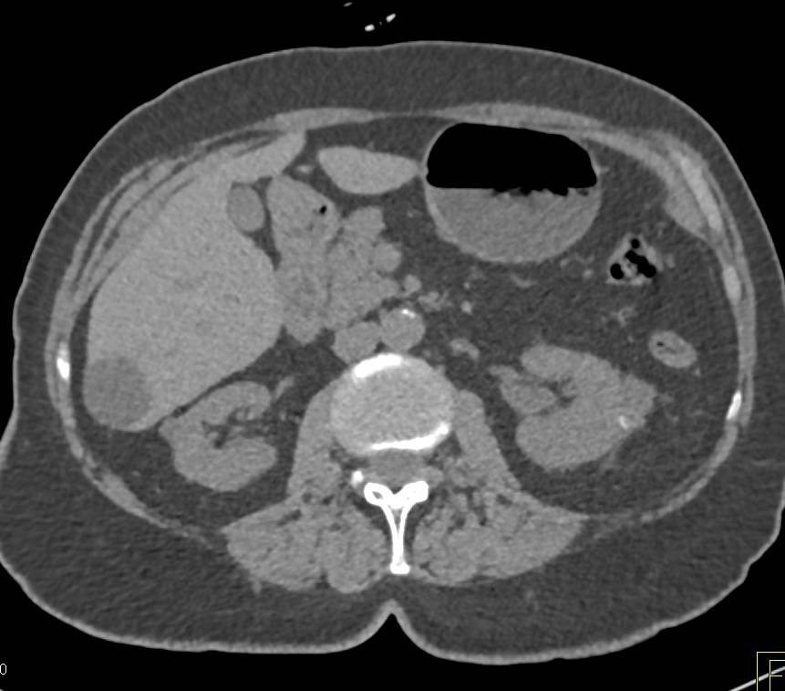 1 cm Left Renal Cell Carcinoma - CTisus CT Scan