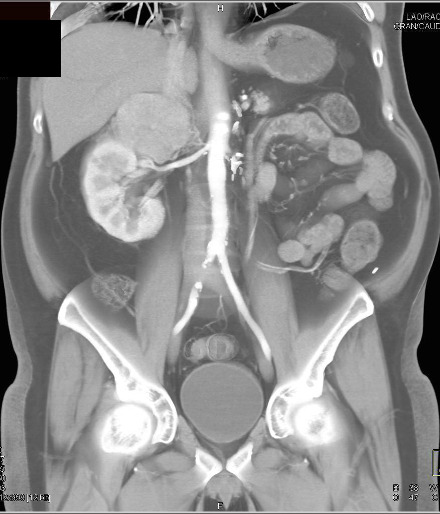 Recurrent Renal cell Carcinoma Metastatic to the Adrenal and Ribs - CTisus CT Scan
