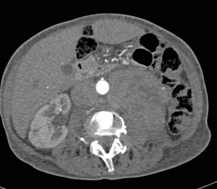 Metastatic Renal Cell Carcinoma to the Right Adrenal Gland and Extensive Paraaortic Adenopathy - CTisus CT Scan