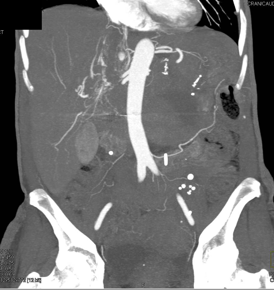 Locally Recurrent Renal Cell Carcinoma with Bone and Muscle Metastases - CTisus CT Scan