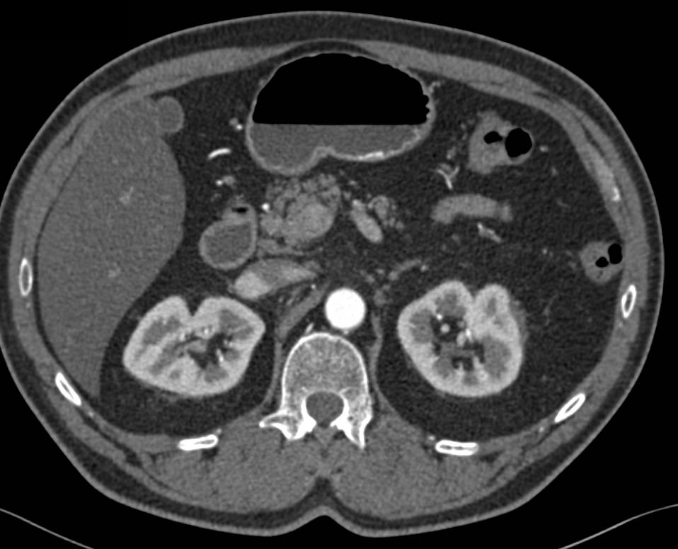 Papillary Necrosis Best Seen on 3D CT - CTisus CT Scan