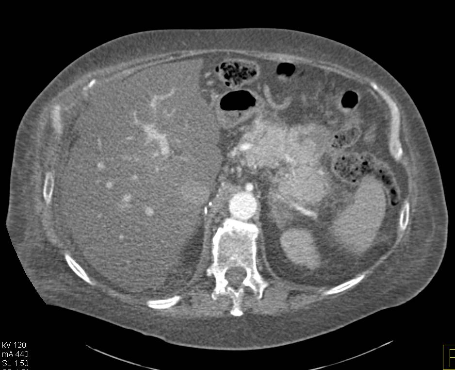 Metastatic Renal Cell Carcinoma to the Pancreas - CTisus CT Scan