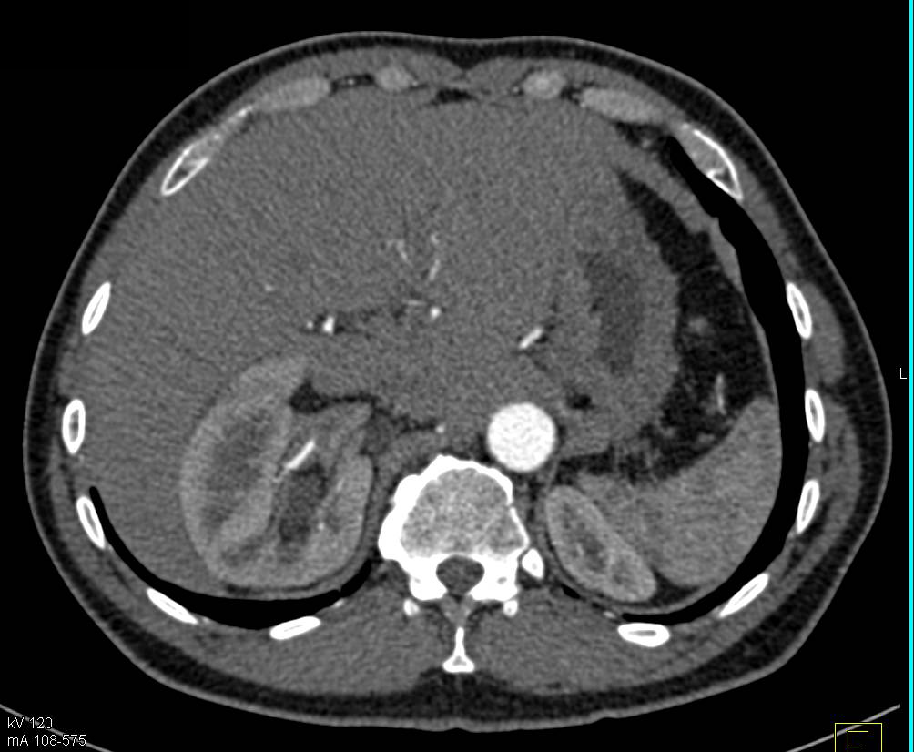 MEST Tumor of the Kidney - CTisus CT Scan