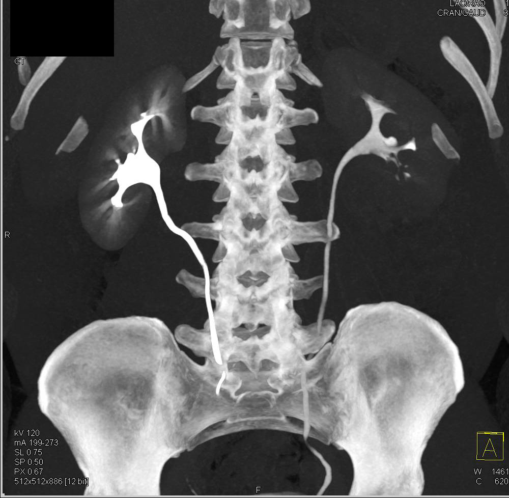 Acute Pyelonephritis with Abscess - CTisus CT Scan
