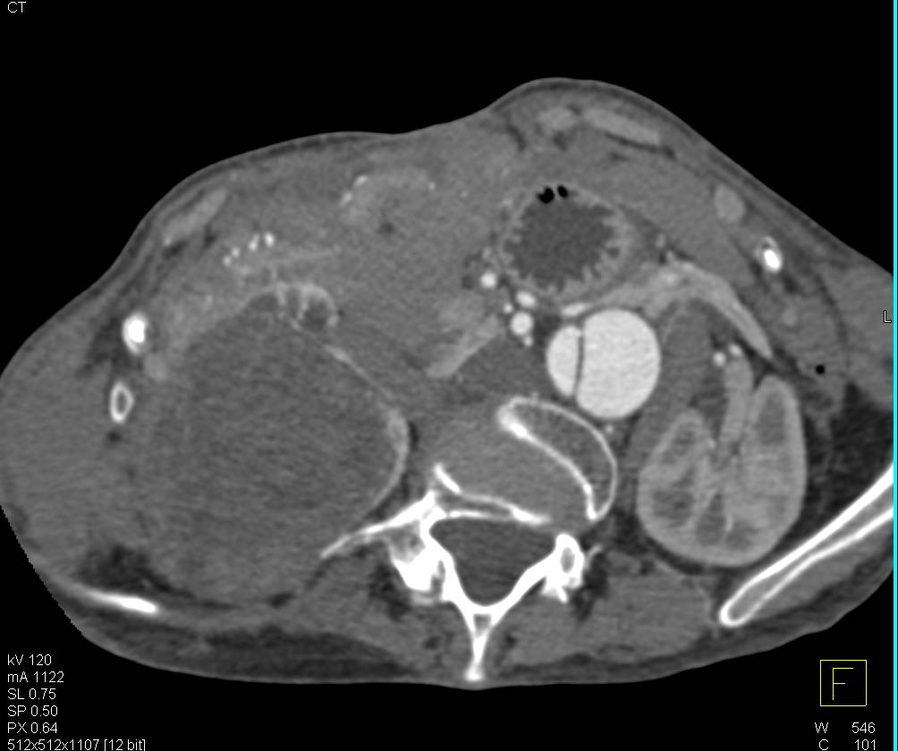 Renal Cell Carcinoma is Hypovascular - CTisus CT Scan