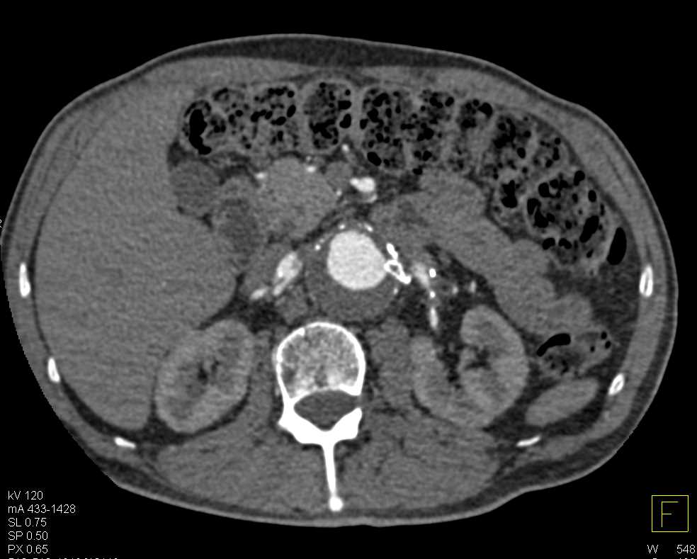 Reimplanted Renal Arteries with Grafts Following Abdominal Aortic Aneurysm (AAA) Repair - CTisus CT Scan