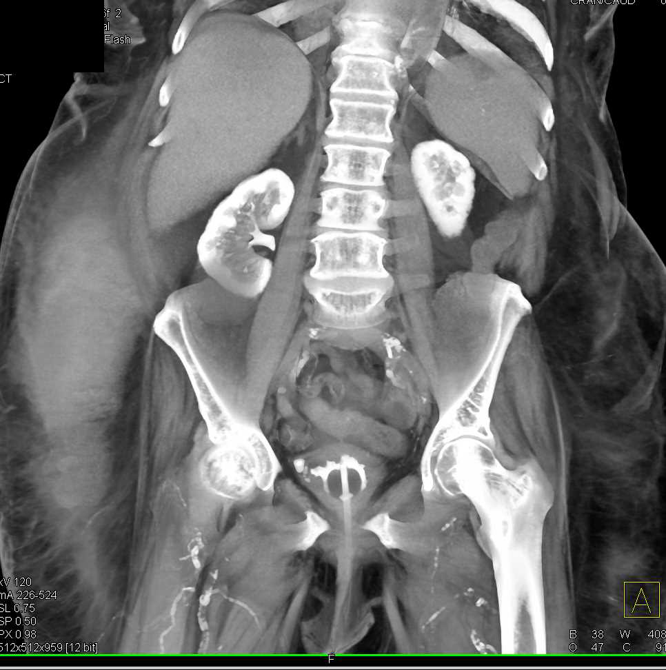 End Stage Renal Disease with Delayed Enhancement of Kidneys - CTisus CT Scan
