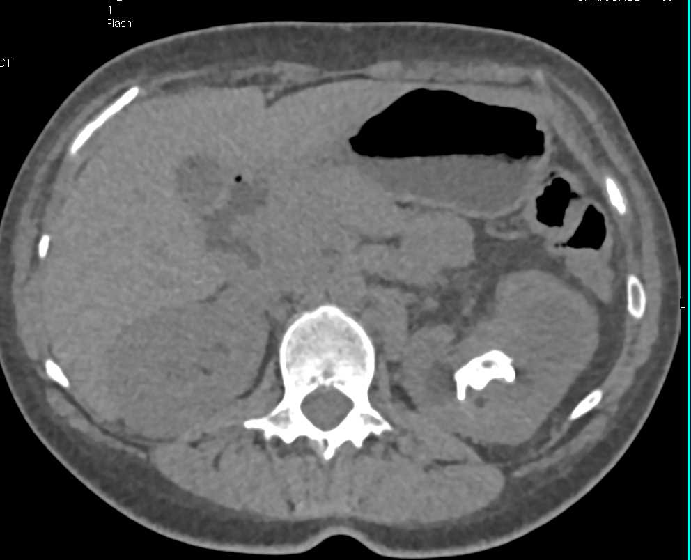 Staghorn Left Renal Calculus and Case of Xanthogranulomatous Pyelonephritis (XGP) - CTisus CT Scan